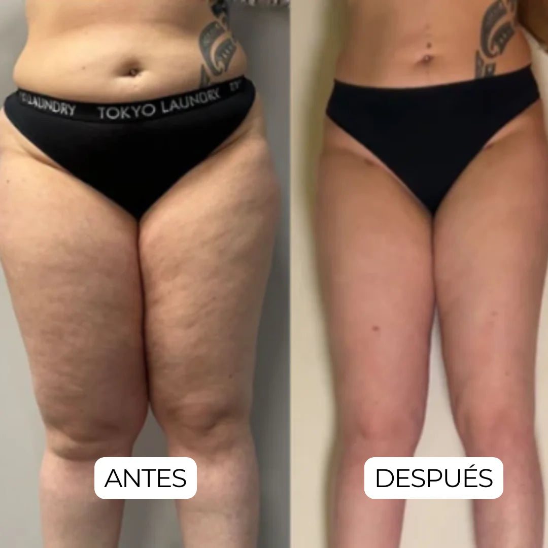 Piernas y cadera antes y después